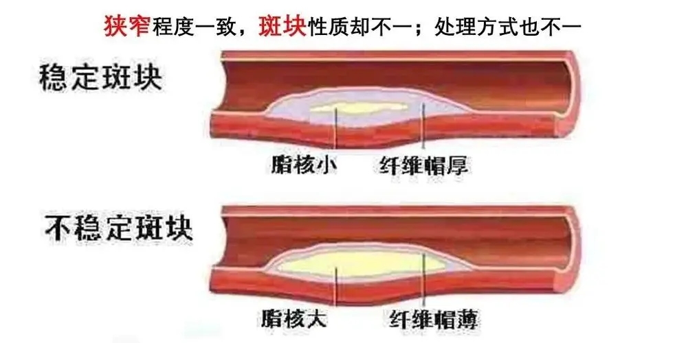 颈动脉斑块的形成