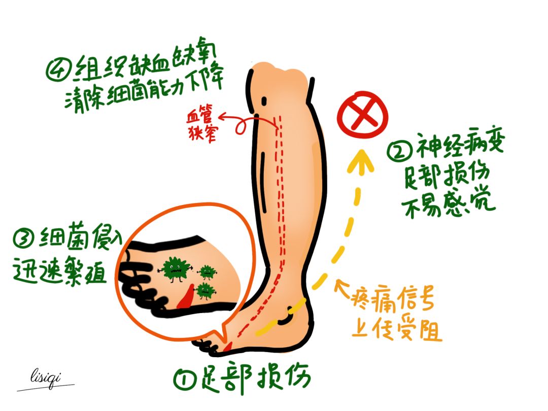 糖尿病足的症状