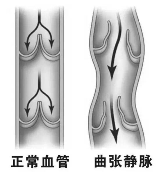 静脉曲张的“危险”