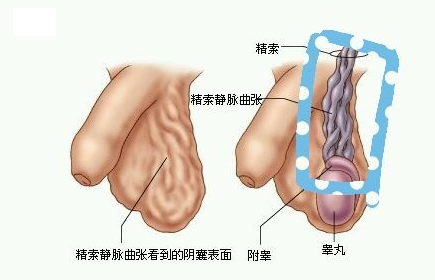 精索静脉曲张的危害