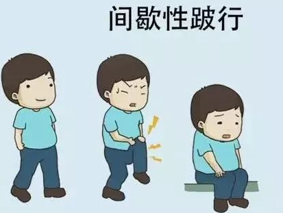 脉管炎症状：间歇性跛行