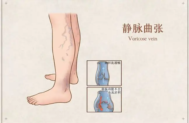 静脉曲张