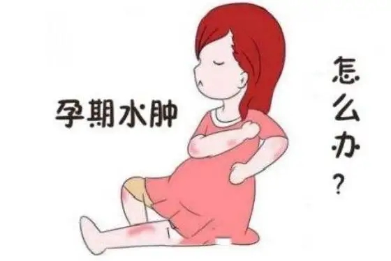 孕期水肿怎么办