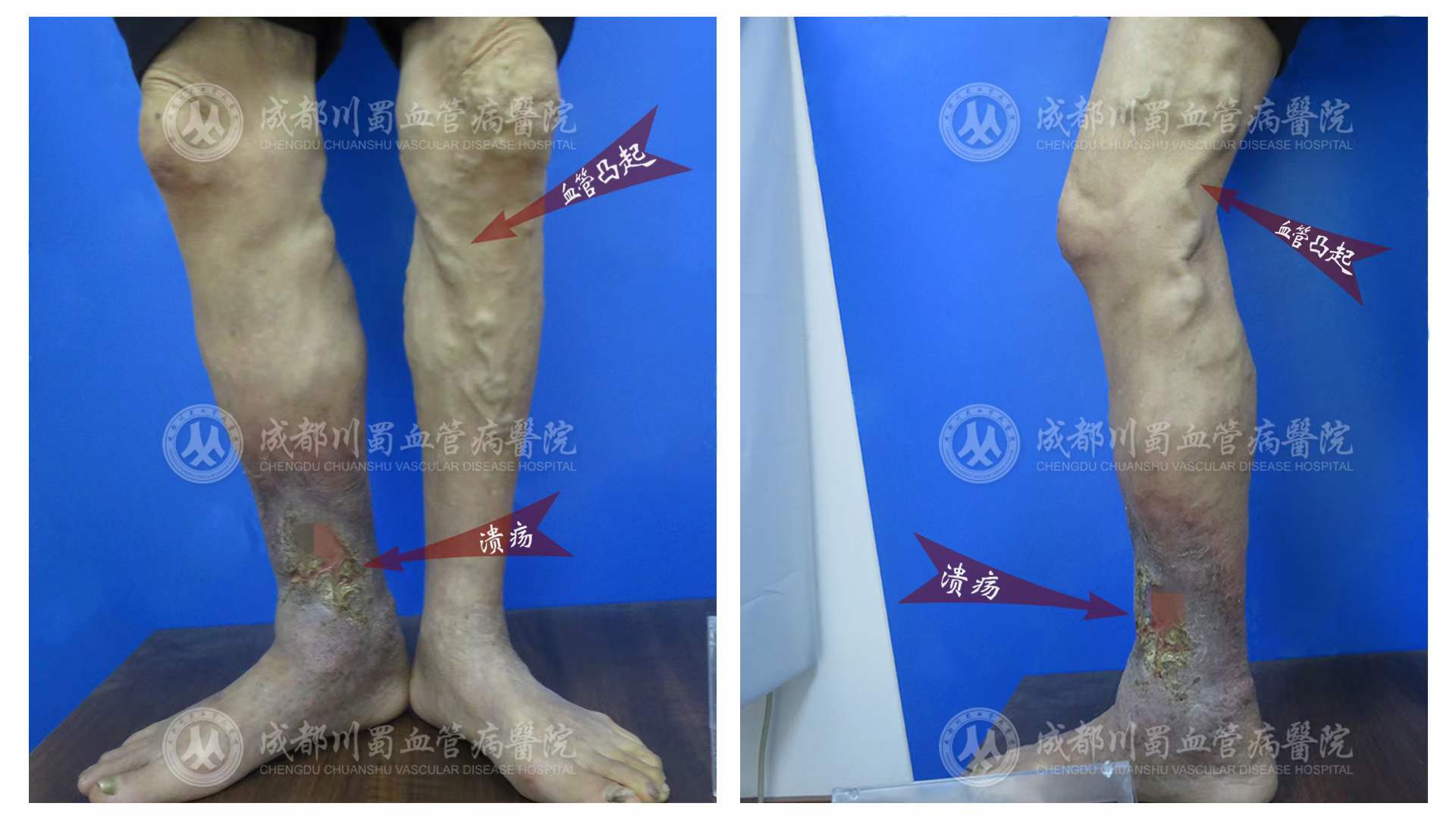 静脉曲张案例患者效果对比