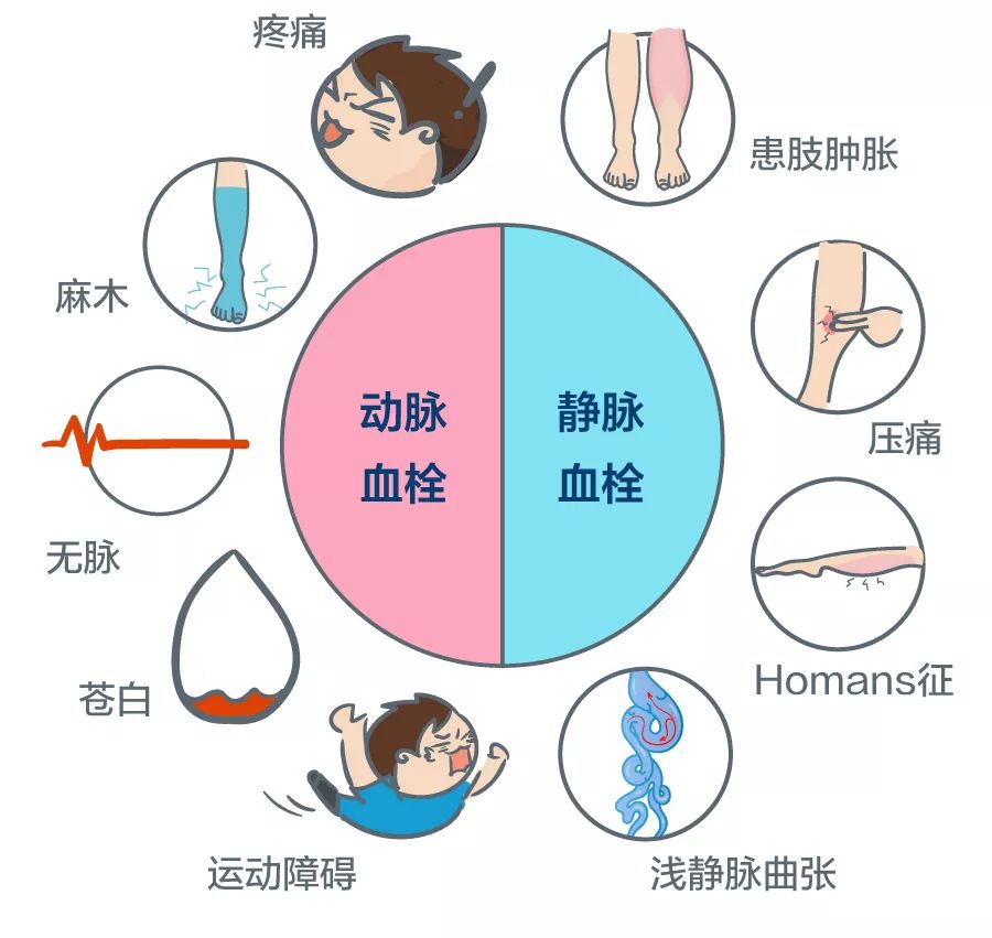 静脉曲张症状