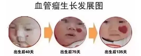 血管瘤生长图