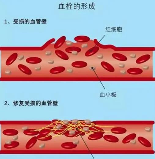 血栓的形成