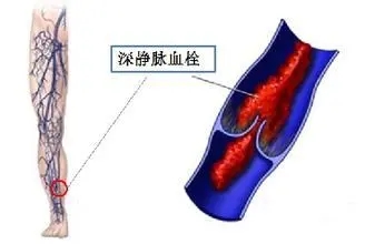 深静脉血栓介入手术