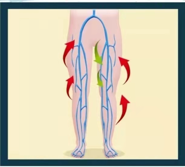 如何预防下肢静脉血栓形成