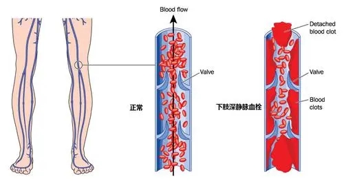 静脉血栓的预防