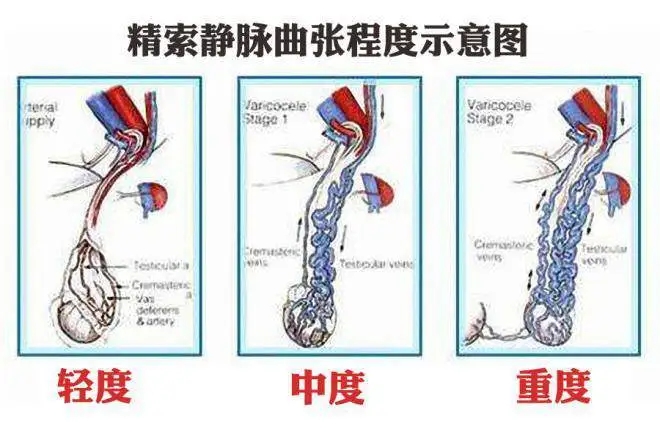 精索静脉曲张的不同时期症状