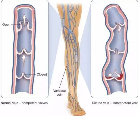 下肢静脉曲张瓣膜受损