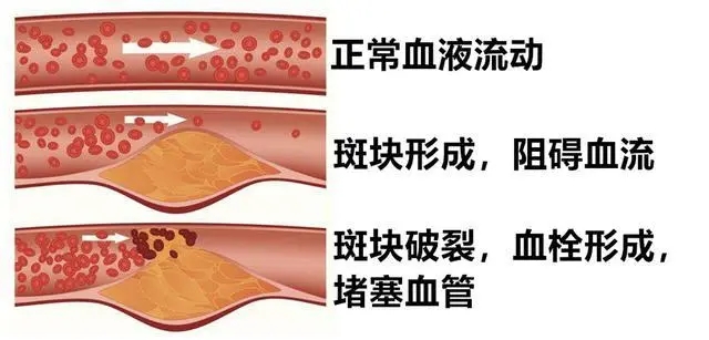 动脉硬化的症状