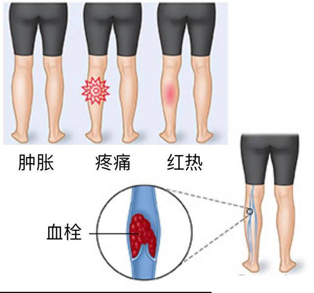 下肢静脉血栓