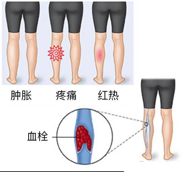 下肢静脉血栓