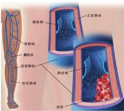 静脉血栓的危害
