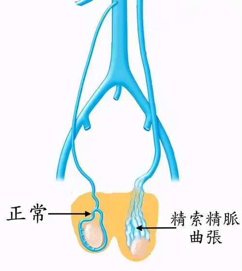 什么是精索静脉曲张
