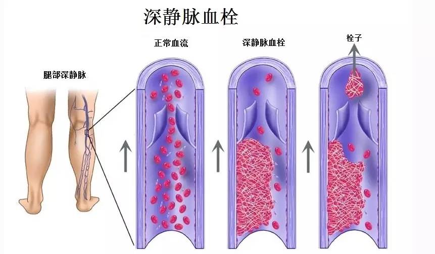 深静脉血栓的危害