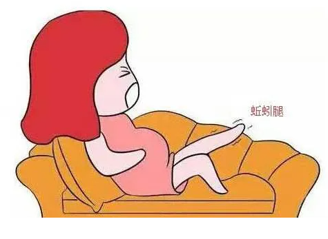 女性容易的静脉曲张