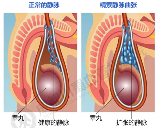 精索静脉曲张