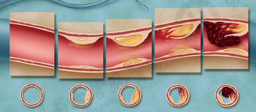 动脉硬化闭塞症