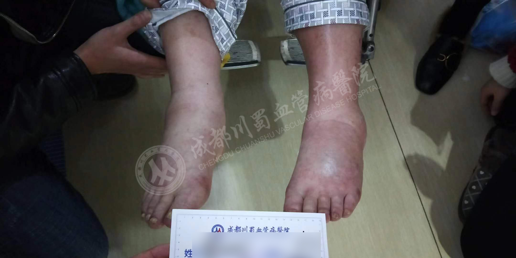 深静脉血栓的症状