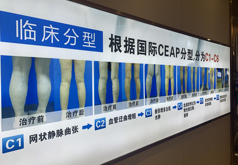 静脉曲张的预防