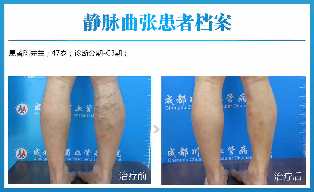 静脉曲张效果对比